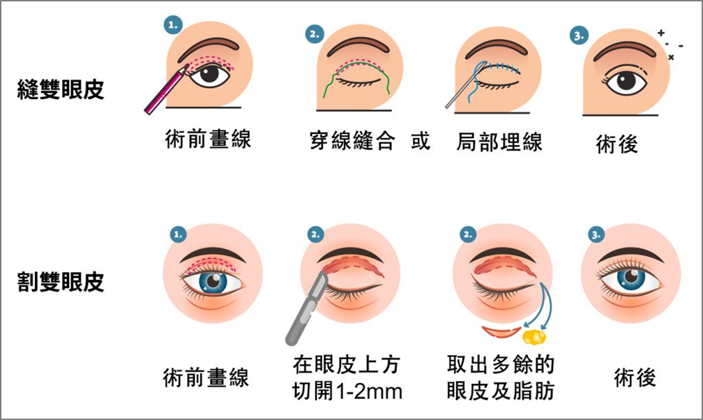 台中雙眼皮_雙眼皮種類_雙眼皮功效_雙眼皮品牌_雙眼皮價格_文心極緻美型診所_縫雙眼皮手術與割雙眼皮手術